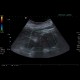 Renal carcinoma, treatment with RFA, follow-up, CEUS: US - Ultrasound